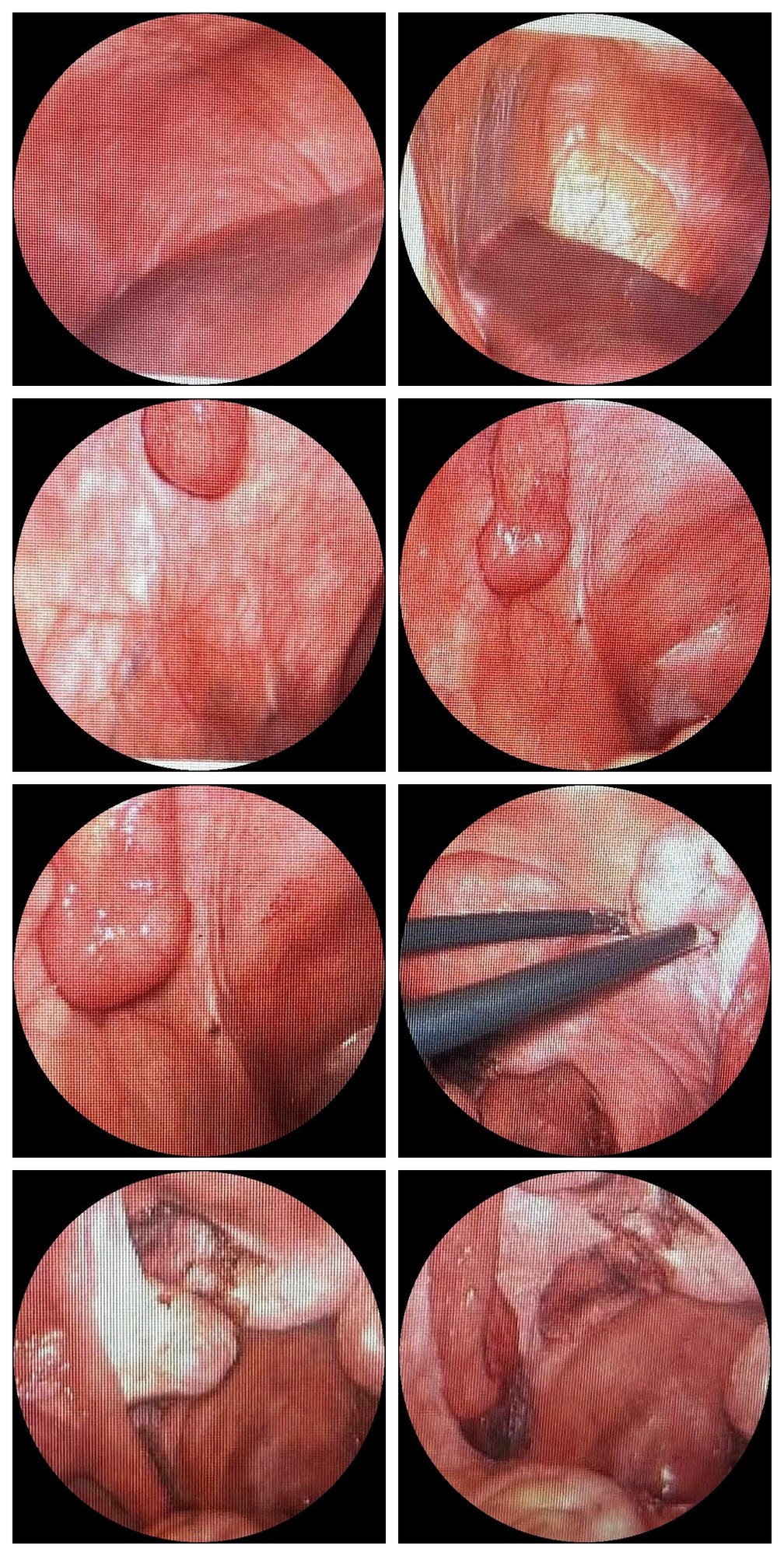 Laparoscopy images from Becky Brooksbank's endometriosis journey